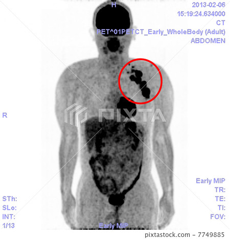 PET / CT photograph of malignant lymphoma PET / CT photograph of malignant lymphoma 7749885