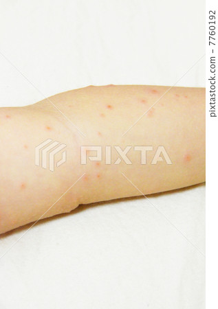 手足口病 7760192