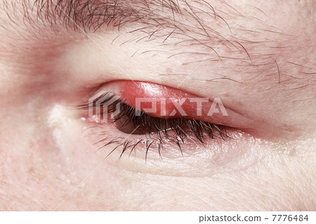 Sore Red Eye. Chalazion and Blepharitis. Inflammation 7776484