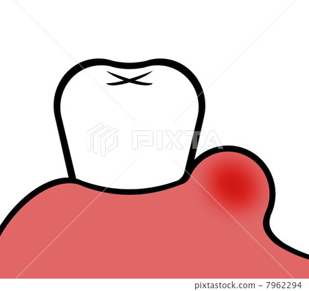 Swelling of gums 7962294