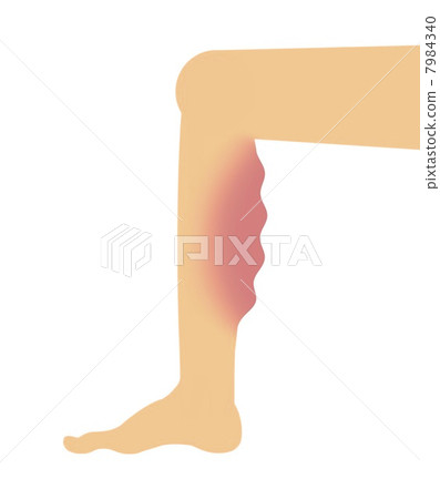 Severe varicose veins of the lower limbs 7984340