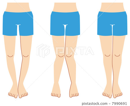 Leg shape illustration set (X leg, O leg, XO leg) - Stock Illustration  [60080071] - PIXTA