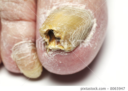 Fungal Nail Infection Fungal Nail Infection 8063947