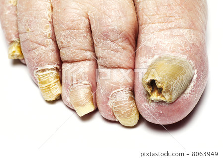 Fungal Nail Infection Fungal Nail Infection 8063949
