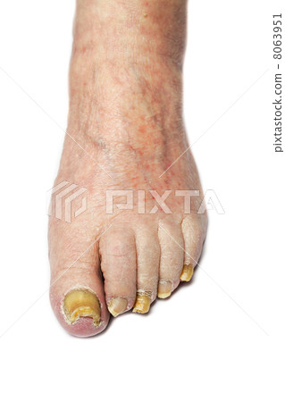 Fungal Nail Infection Fungal Nail Infection 8063951