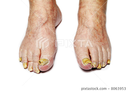 Fungal Nail Infection Fungal Nail Infection 8063953