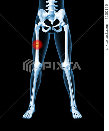 Female skeleton with broken leg bone 8100126