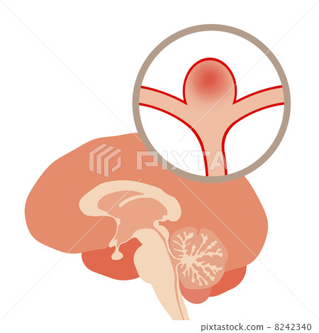 Cerebral aneurysm Cerebral aneurysm 8242340