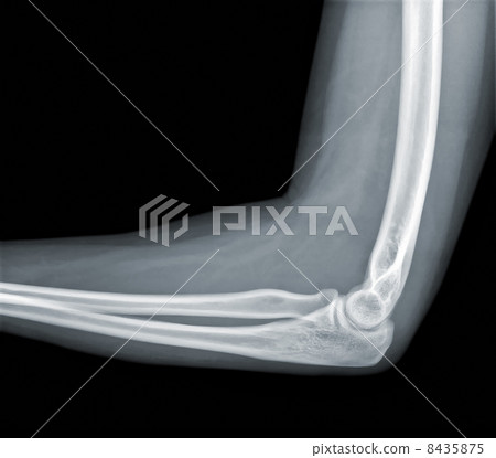 X-ray view of elbow X-ray view of elbow 8435875