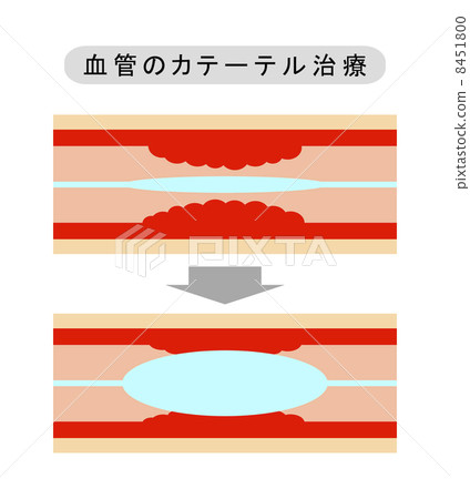 Catheterization of blood vessels Catheterization of blood vessels 8451800
