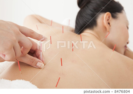 Acupuncture treatment 8476804