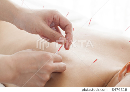 Acupuncture treatment 8476816