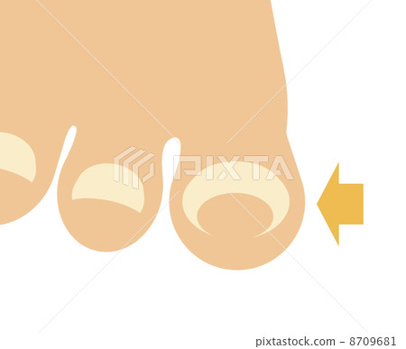 傷口釘 傷口釘 8709681