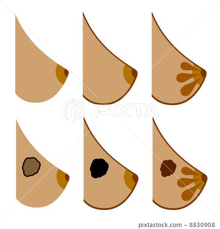 breast cancer 8830908