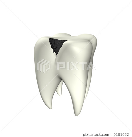 Caries Tooth 3D Caries Tooth 3D 9101632