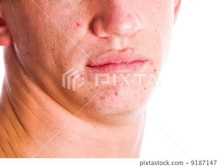 Acne Face 9187147