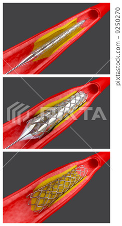 Angioplasty 9250270