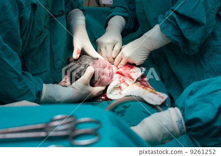 cesarean section cesarean section 9261252