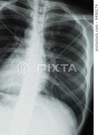 chest xray scan chest xray scan 9490274