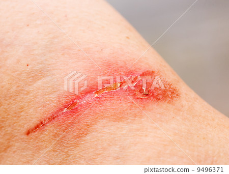 Burn Scar 9496371