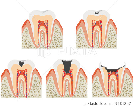 Caries Caries 9681267
