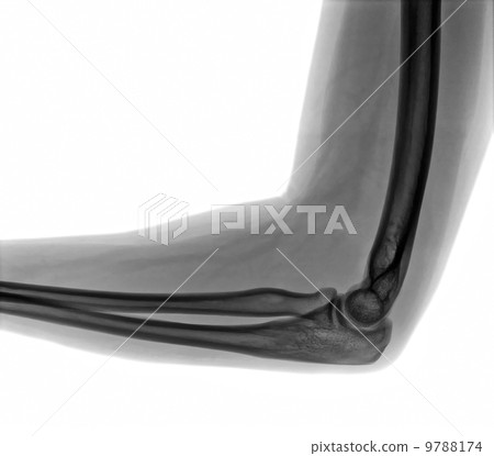 Elbow X-ray view Elbow X-ray view 9788174