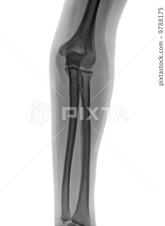 Elbow X-ray negative 9788175