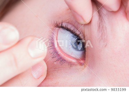 Close up of inserting a contact lens 9833199