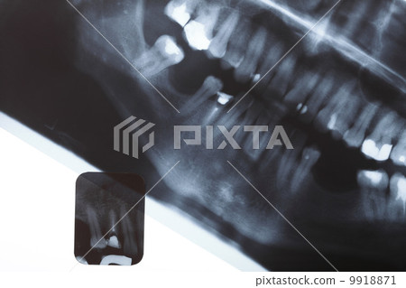 X-ray scan of humans teeth X-ray scan of humans teeth 9918871