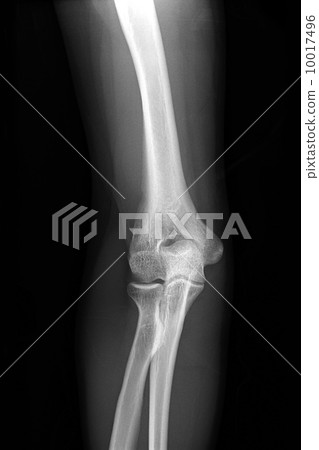 右肘的X射線照片 右肘的X射線照片 10017496