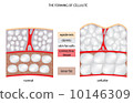 forming cellulite 10146309