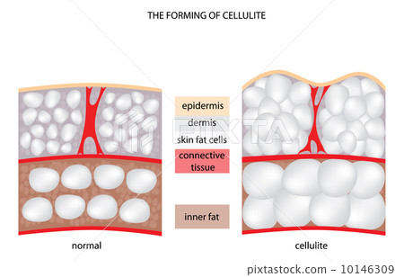 forming cellulite forming cellulite 10146309