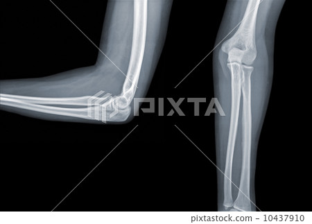 X-ray elbow 10437910