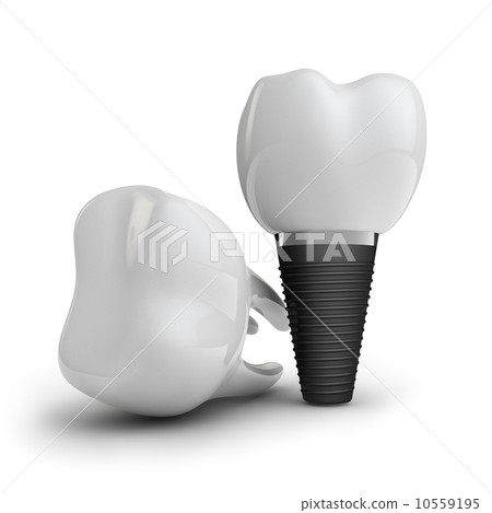 tooth implant tooth implant 10559195