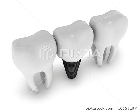 tooth implant tooth implant 10559197
