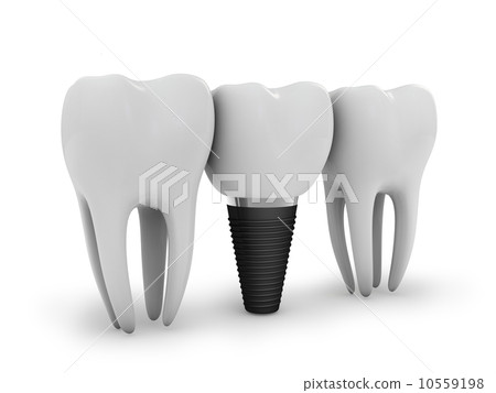 tooth implant tooth implant 10559198