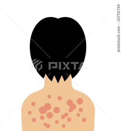 帶狀皰疹在背部做 10756784