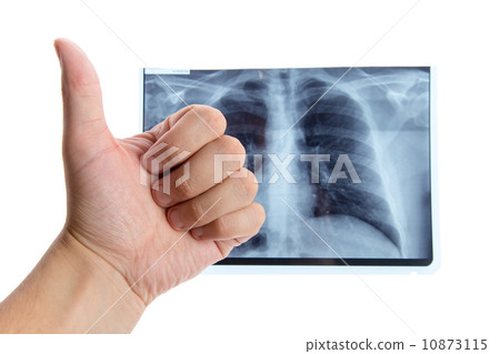 Male hand showing thumbs up next to lung radiography Male hand showing thumbs up next to lung radiography 10873115