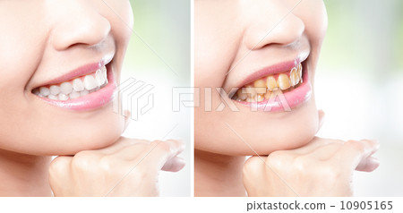 woman teeth before and after whitening 10905165