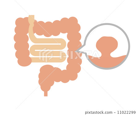 Colonic polyp 11022299