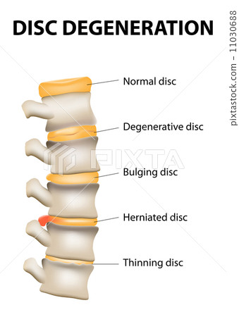 Disc degeneration 11030688
