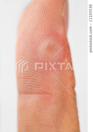 verruca and blister formation after being frozen verruca and blister formation after being frozen 11103536