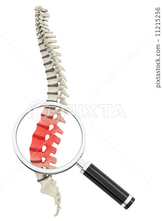 disc prolapse 11215256