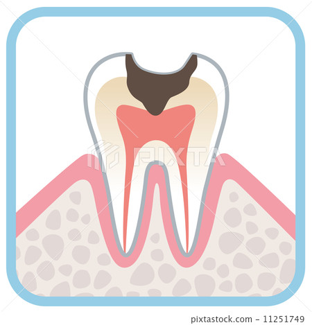 Sectional view of teeth decayed tooth Sectional view of teeth decayed tooth 11251749