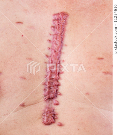 The hypertrophic big scar or swell cicatrix. The hypertrophic big scar or swell cicatrix. 11254616