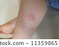 被蚊子刺傷的嬰兒的腳 11359865