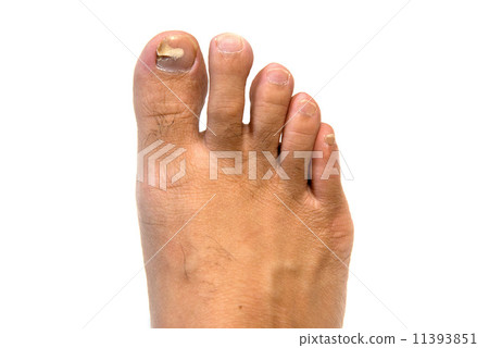 腳釘受傷 11393851