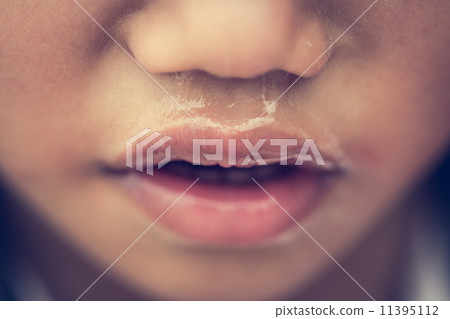 runny nose runny nose 11395112