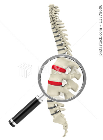 Disc prolapse Disc prolapse 11578606