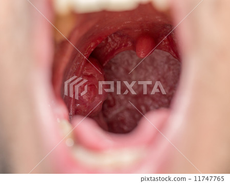 Open mouth view of tonsils 11747765
